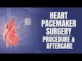 Heart Pacemaker Surgery: Procedure & Aftercare | Medicover Hospitals