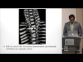 Hemivertebrae - Jaspreet Johal, M.D.