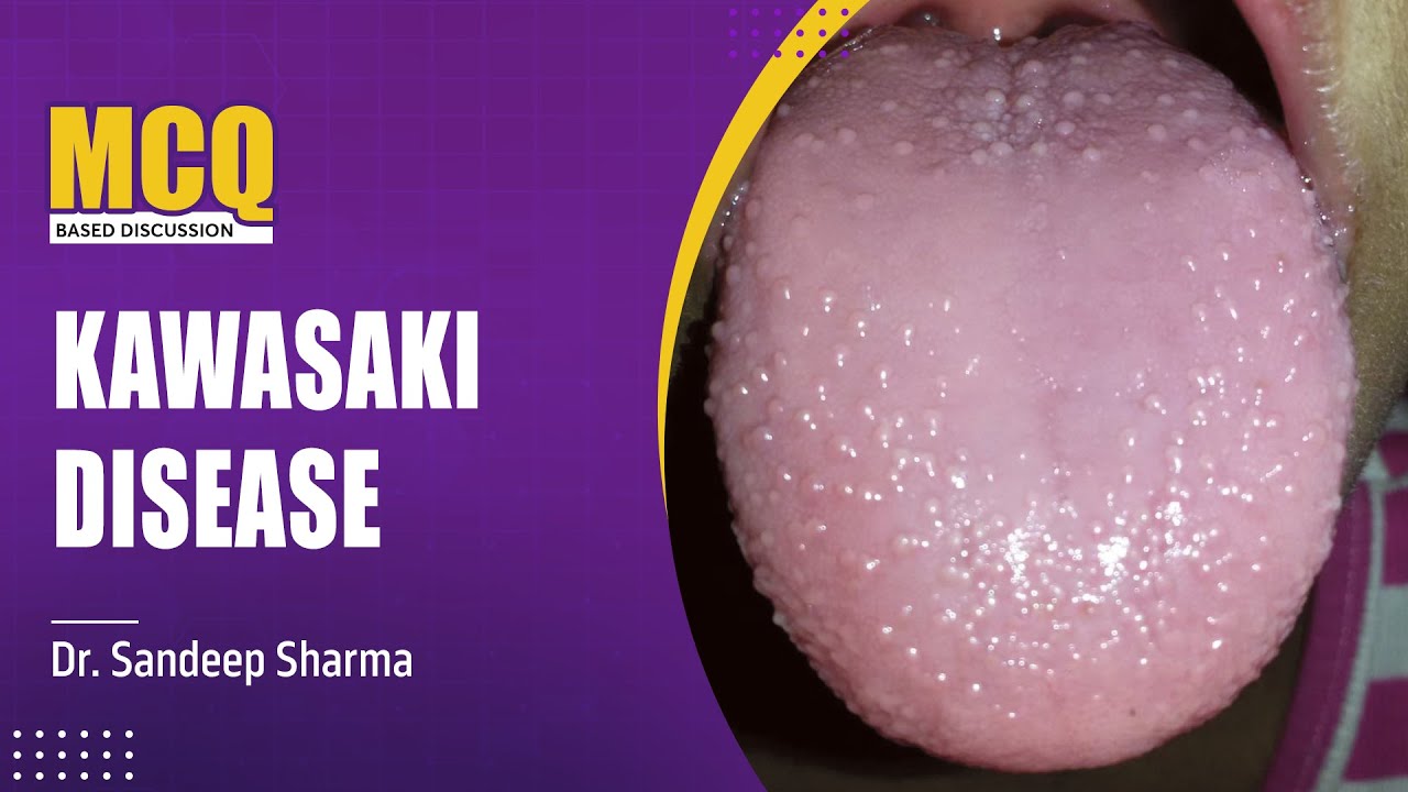 Kawasaki Disease Dr. Sandeep Sharma PrepLadder NEETSS YouTube