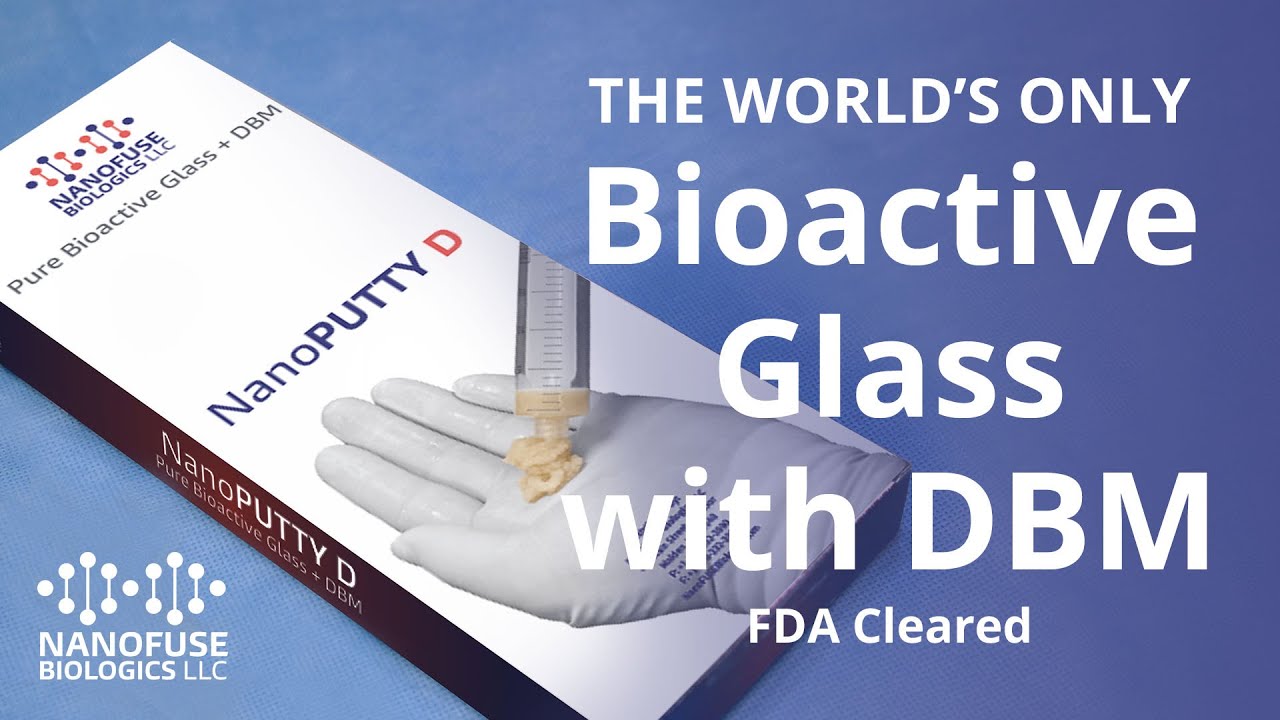 Spine Fusion with NanoFuse Biologics - World's Only FDA Certified BioActive Glass with DBM