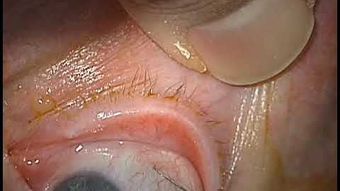 Subconjunctival anaesthesia