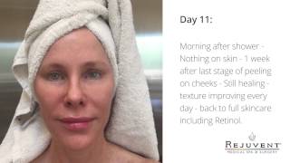 Reverse Sun Damage with  Photodynamic Therapy (PDT)  Levulan with FotoFacial