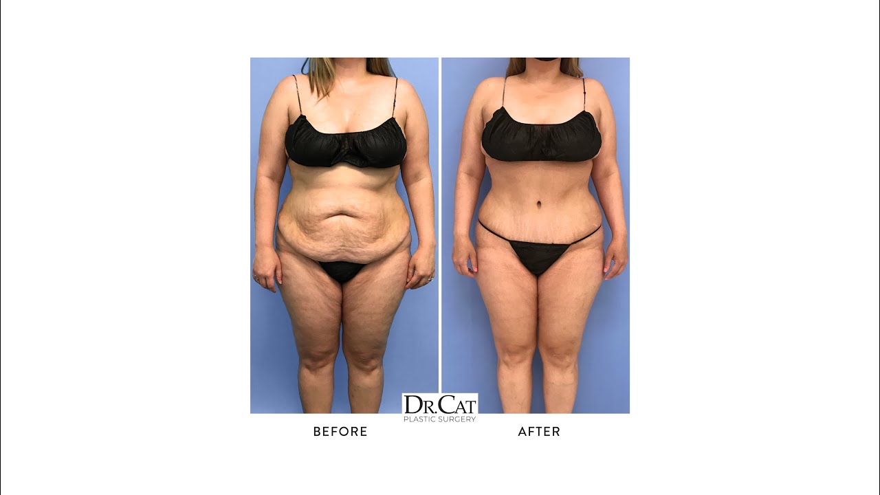 Amazing Transformation after a Tummy Tuck with Pubic Lift and