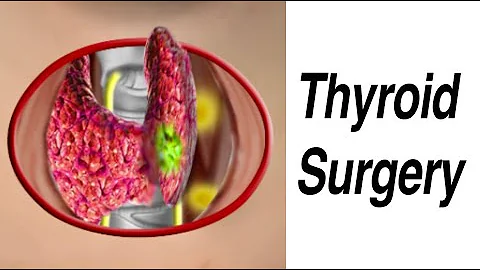 Thyroid Surgery to Remove Nodule Suspicious for Cancer - DayDayNews