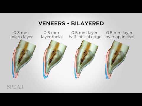 Restorative Materials for Veneers