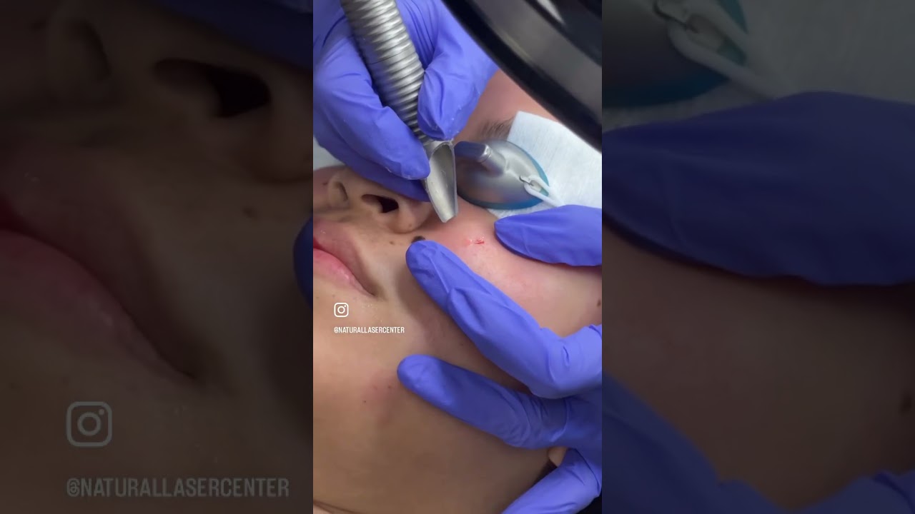 Elimina lunares en segundos!