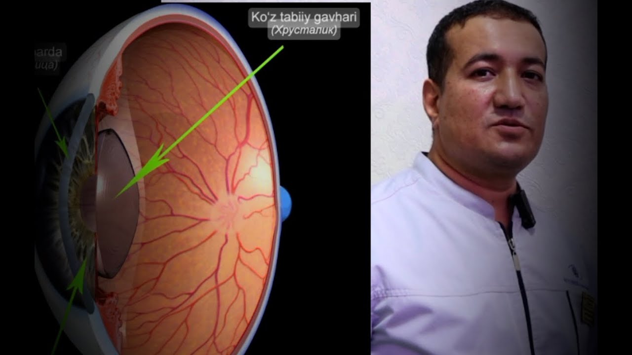 KO'ZDAGI_GAVHARNI_OPERATSIYA_YOKI_ALMASHTIRISH