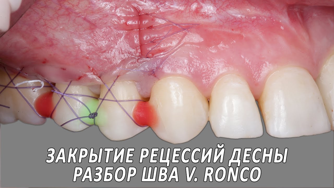 Видео-разбор операции по закрытию рецессий десны VISTA + tunnel, разбор ...