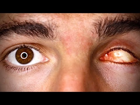 ვიდეო: რამდენად ზუსტია შემოპარული თვალი?