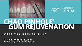 CHAO Pinhole Gum Rejuvenation - What You Need To Know with Dr Samintharaj Kumar (FULL VERSION)