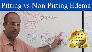 Edema | Pitting  vs Non Pitting Edema