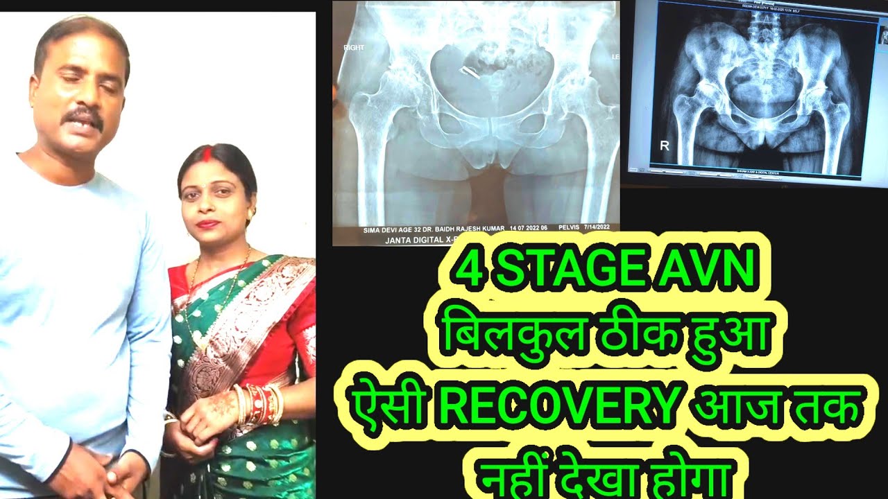 I BEAT 4 STAGE AVN AND LIVED TO TELL! 😍