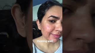 You asked for this video acnescartreatment shorts mnrf microneedling