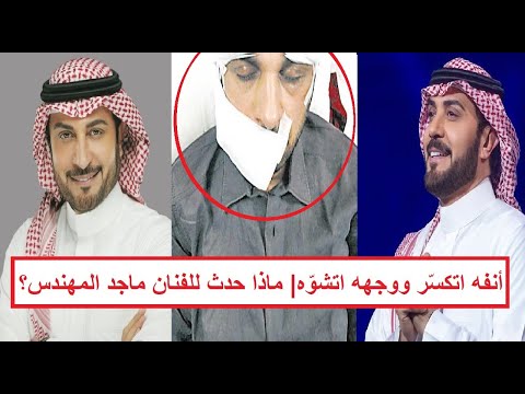 أنفه اتكسر ووجهه ات شو ه دخول الفنان ماجد المهندس العناية المركزة بسبب حالته الصحية المتدهورة