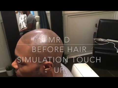 Video thumbnail: Mr. D Update: Hairline Correction | The Hair Simulation Company