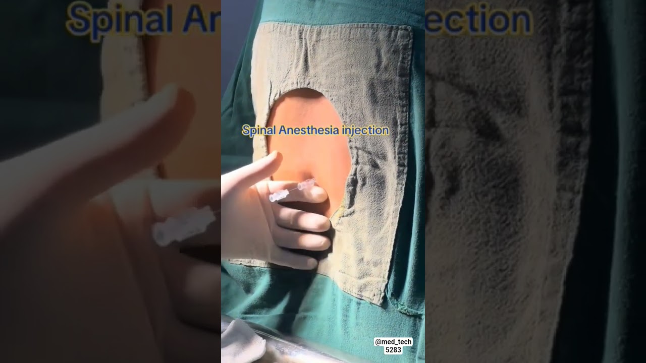 LOCAL ANESTHESIA SPINAL BLOCK