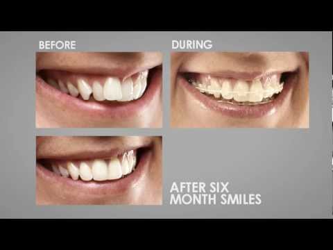 Six Month Smiles in One Minute