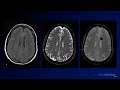 Neuroradiology Board Review - Brain Tumors - Case 12