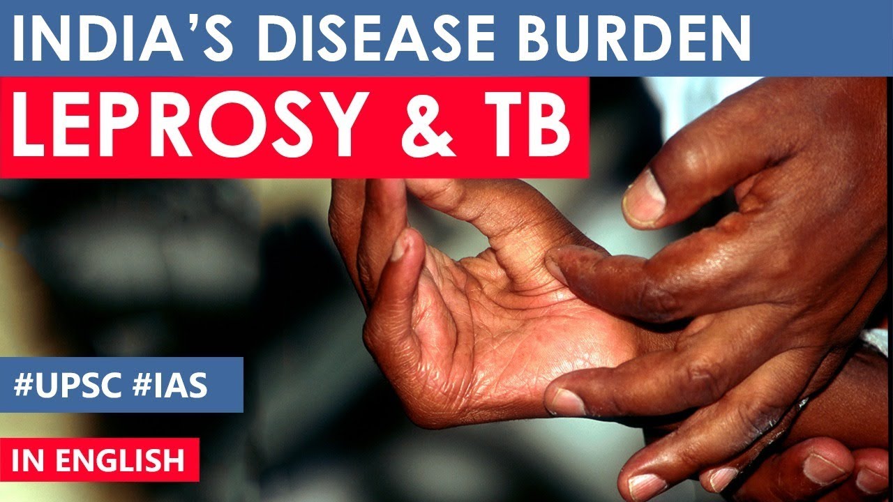diseases caused by virus India's Disease burden and mission, India to screen 25 crore children for leprosy and tuberculosis