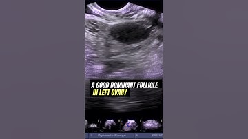 Dominant Ovarian Follicle   #Ultrasound #pregnancy #infertility #ovulation