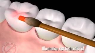 LANAP Laser Periodontal Therapy