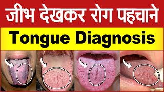 Tongue Diagnosis - Cracked Tongue Causes and Acupressure Treatment || TCM Diagnosis What Causes Crack On The Tongue