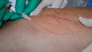 Varicosas del Reino Unido venas estadísticas