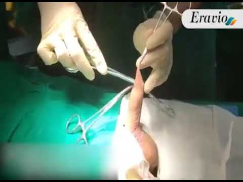Circumcision zsr - YouTube