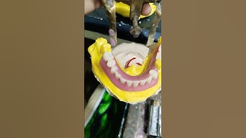 Removable Partial Denture Ready For Try In 😁😁#rpd #dentalartbyhaider #dentures