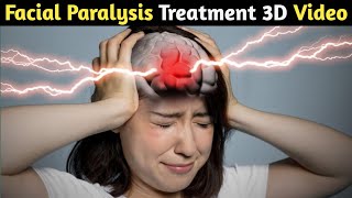 Facial Paralysis treatment//information for medical students Hindi/Urdu by Saeed pharma