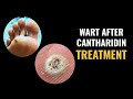 Wart After Cantharidin Treatment