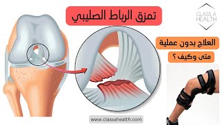 تمزق الرباط الصليبي، متى وكيف يمكن العلاج بدون عملية؟