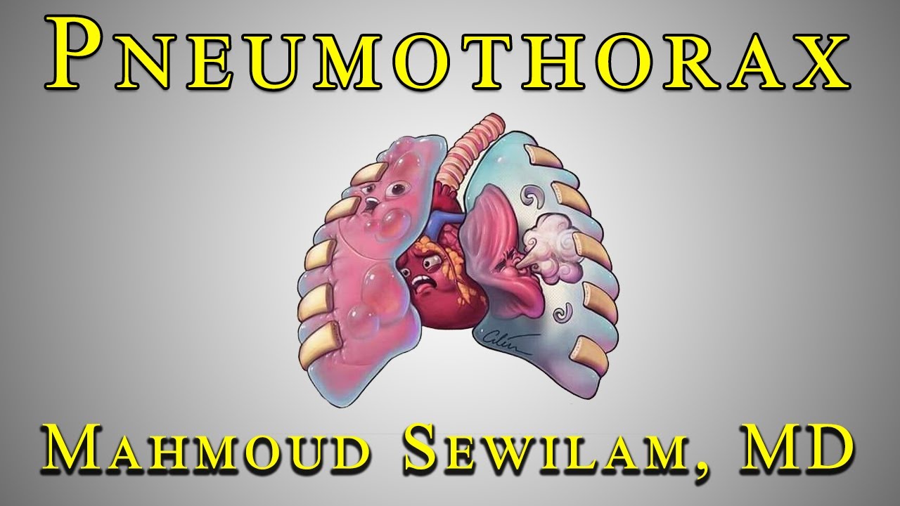 شرح ال pneumothorax دكتور سويلم