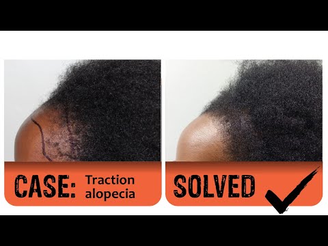 A solution for traction alopecia