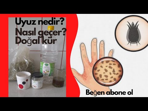 uyuz nasıl geçer? uyuz nedir? Doğal kurler - YouTube