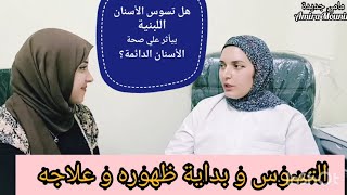 تأثير تسوس الاسنان اللبنية علي صحة الاسنان#التسنين #أسنان_الطفل