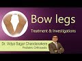 Hi9 | Bow legs Treatment & Investigations ? | Bow legs | Knock Knees | Dr.Vidya Sagar Chandanakere