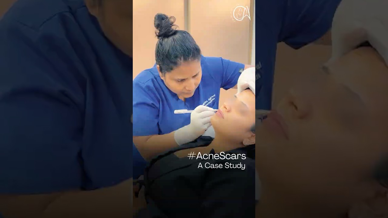 Video poster for Acne Scar Treatment in Gurgaon | Real Case Study | Dr. Akanksha Agarwal