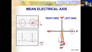 Simple ways to determine the Mean Electrical Axis on ECGs of dogs and cats