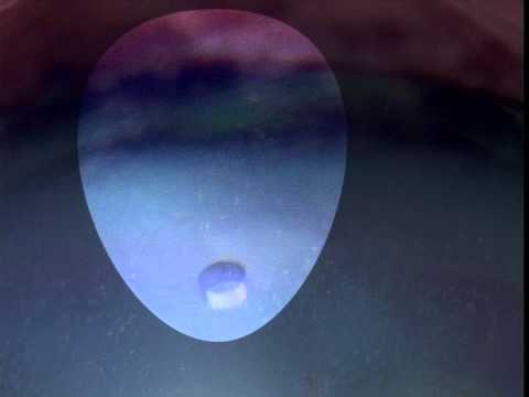 [Айриум Нүдний Эмнэлэг] [Айриум Нүдний Эмнэлэг] Аква ICL Плюс - Нүхт ICL Маск