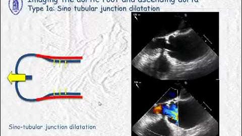 Imaging of aortic root and ascending aorta - what the surgeon has to know