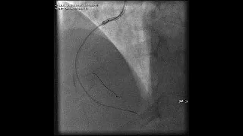Complex PCI for RCA CTO with bifurcation at distal cap video 6