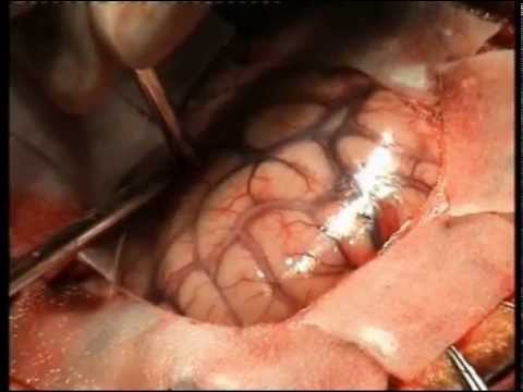 Brain Tumor Surgery - Brain Tumor Surgery Risks Hqdefault