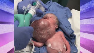 Baby Born with Giant Tumor? Plus, Man Survives a Shocking Spear Fishing Accident