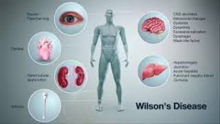 مرض ويلسون Wilson’s Disease