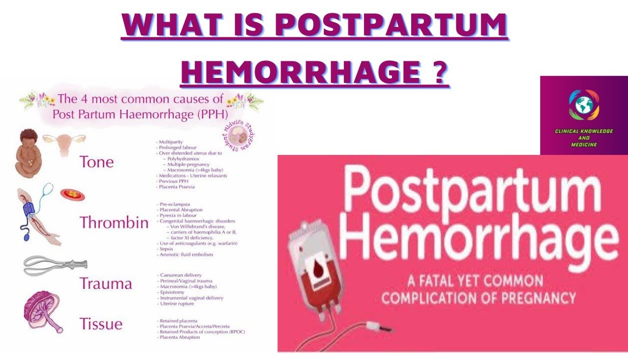 PPH Post Partum Hemorrhage Definition Types Risk Factors