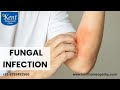 FUNGAL INFECTION फफूंद का संक्रमण