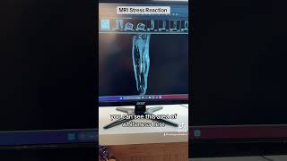 Stress Fracture / Stress Reaction Tibia MRI Shin Splints Stress Reactions