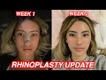 RHINOPLASTY UPDATE