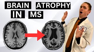 Brain Atrophy in Multiple Sclerosis Explained by Neurologist by Dr. Brandon Beaber 5,072 views 7 months ago 15 minutes